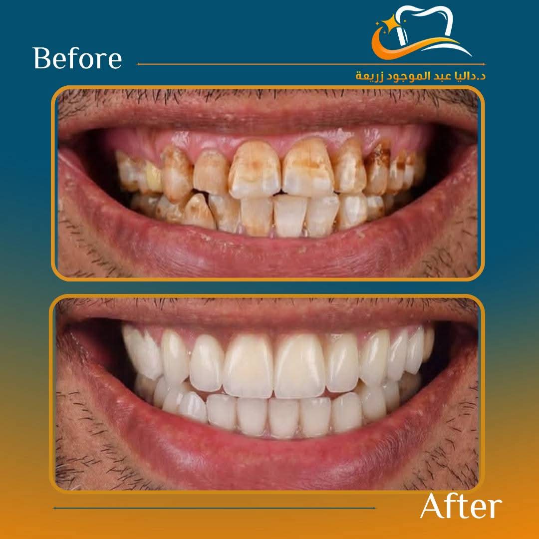 Smile Transformation