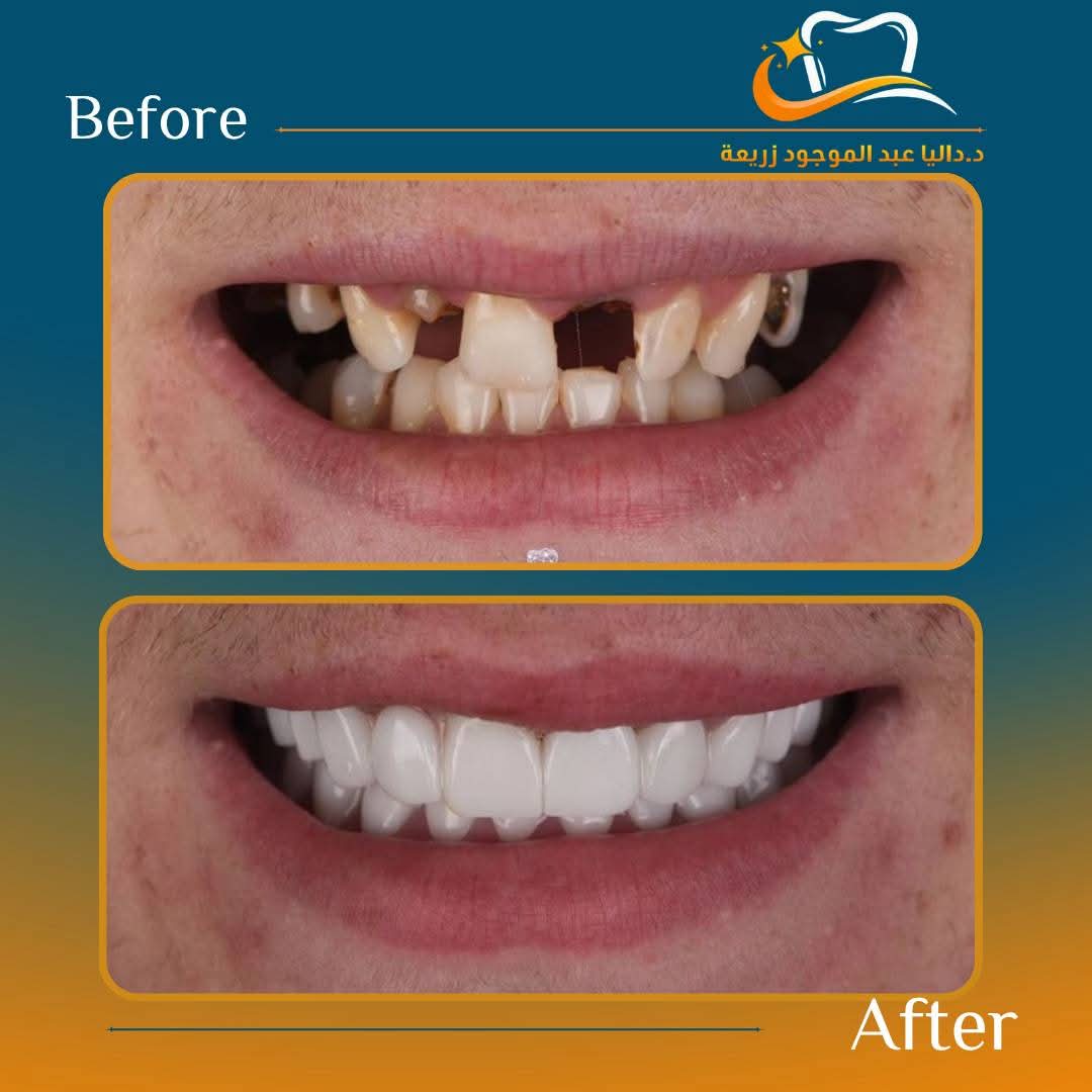 Dental Restoration